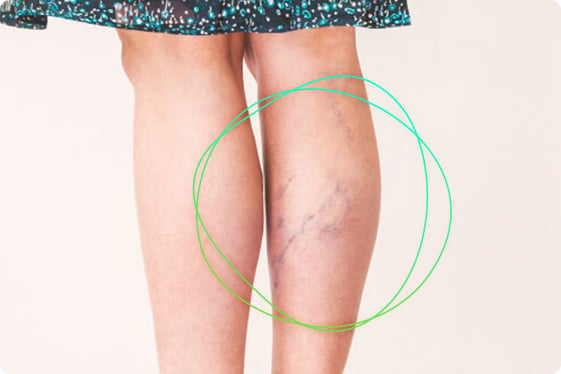 Spider-Veins-2-circled