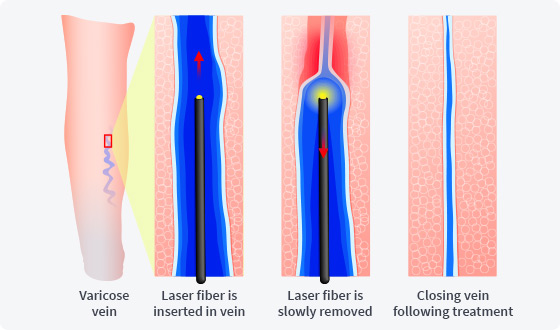 Treatment | Vein Disease | Center For Vein Restoration