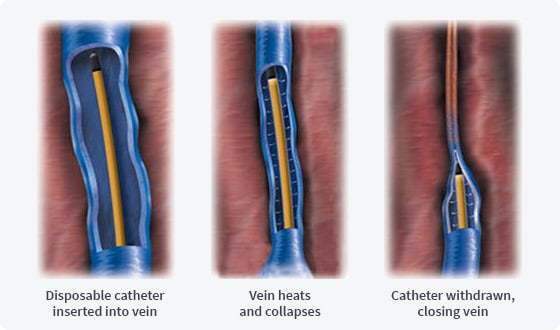 Treatment_img_radiofrequency